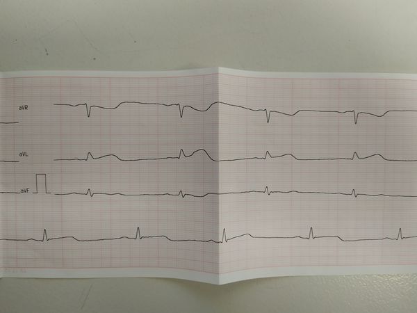 Подъём сегмента ST в отведении AVL Подъём сегмента ST в отведении AVL