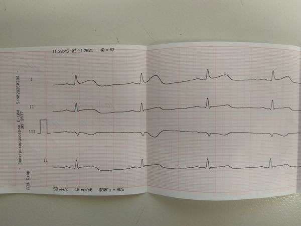 Подъём сегмента ST в I и II отведениях Подъём сегмента ST в I и II отведениях
