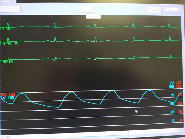Восстановление сегмента ST в I и II отведениях Восстановление сегмента ST в I и II отведениях