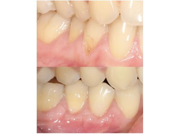 До и после лечения До и после лечения