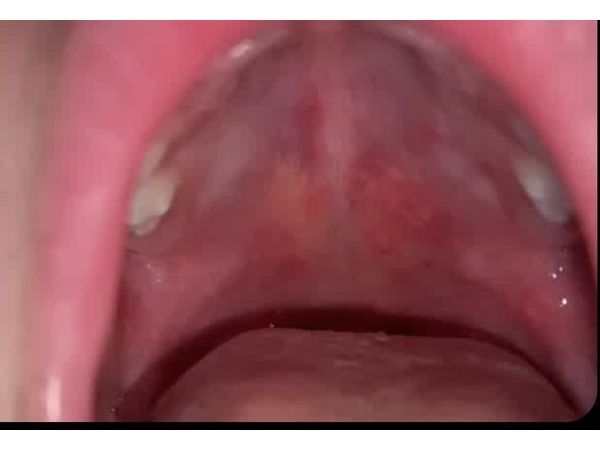 Афты (язвочки) во рту Афты (язвочки) во рту