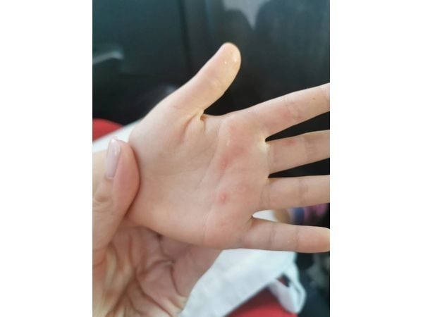 Сыпь на ладонях Сыпь на ладонях