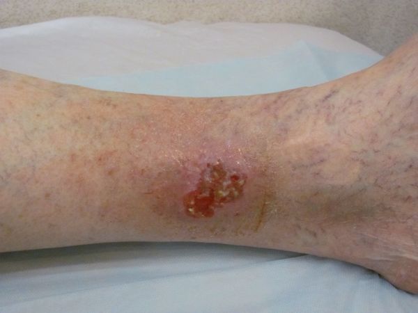 Язвенный дефект при первом обращении в 2012 году Язвенный дефект при первом обращении в 2012 году