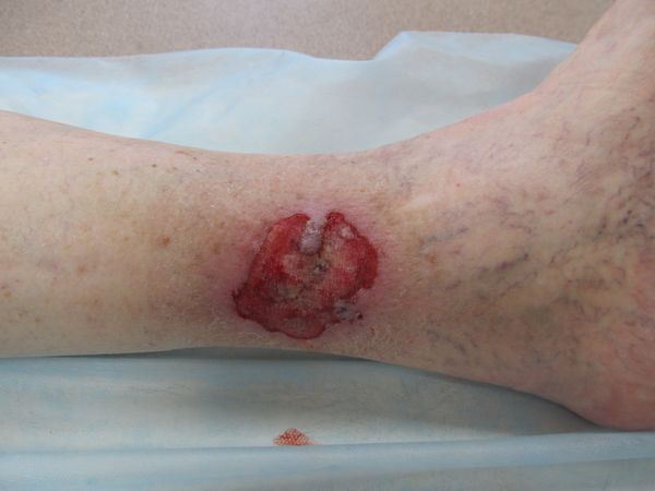 Язвенный дефект при обращении в 2017 году Язвенный дефект при обращении в 2017 году