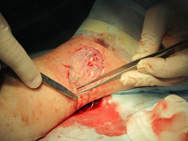 Фиксация лоскута кожи к подготовленному для пересадки месту Фиксация лоскута кожи к подготовленному для пересадки месту