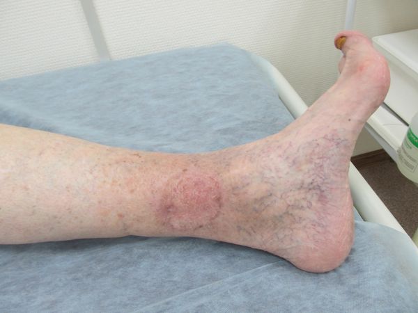 Результат лечения через 5 месяцев после операции Результат лечения через 5 месяцев после операции