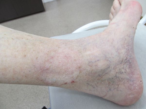 Результат лечения через 12 месяцев после операции Результат лечения через 12 месяцев после операции