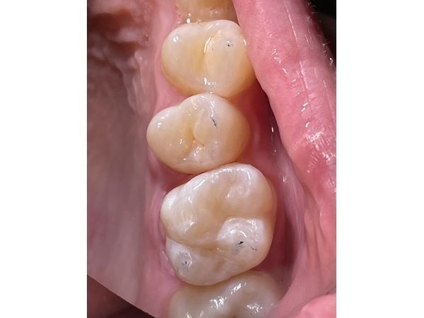 Проверка контактов с зубами-антагонистами