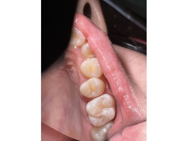 Вид полости рта после лечения