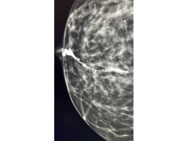 Дефект наполнения протока при дуктографии