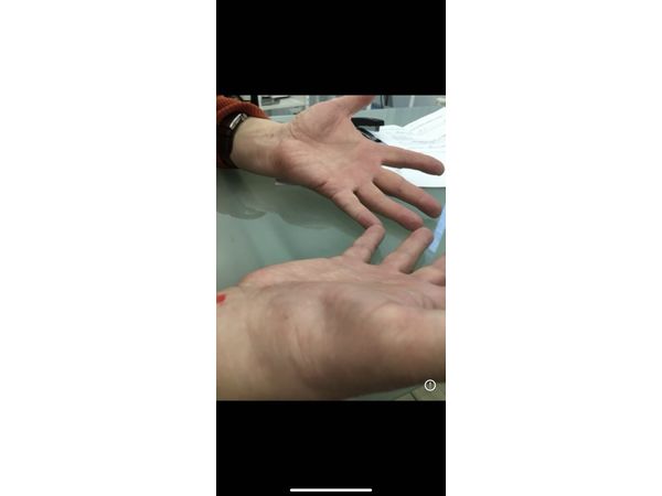 Выраженная гипотрофия мышцы Выраженная гипотрофия мышцы