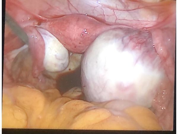 Двусторонние эндометриоидные кисты 