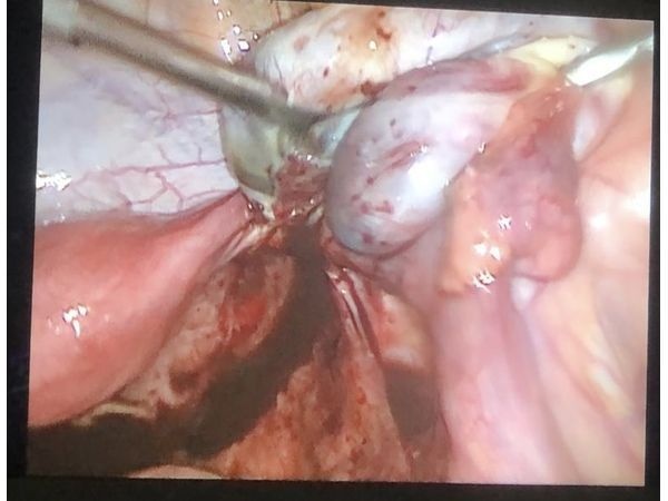 Лапароскопическая операция