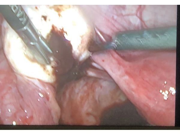 Этап операции