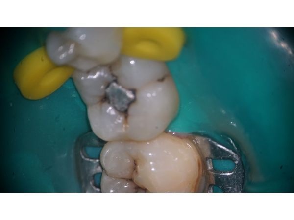 Старая пломба