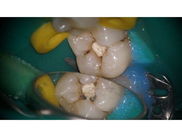 Частичное снятие пломбы