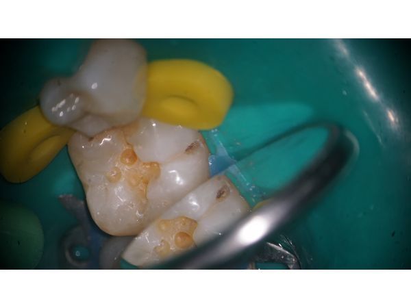 Кариес на щёчной поверхности зуба