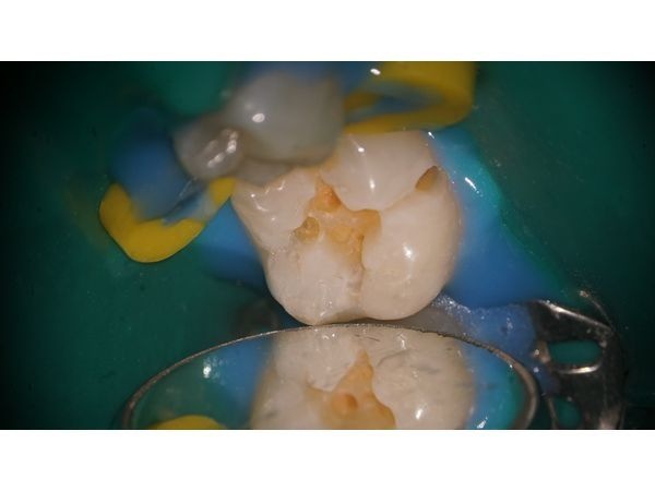 Состояние после обработки кариозных полостей