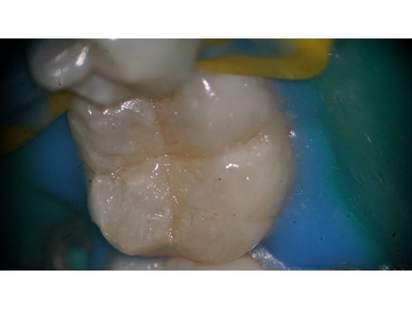 Постановка пломбы