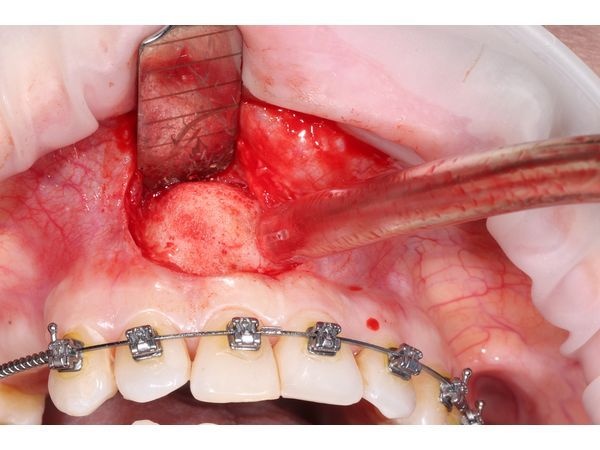 Доступ к кисте 