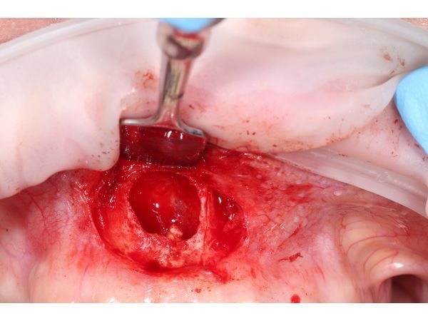 Верхушка корня после удаления кисты 