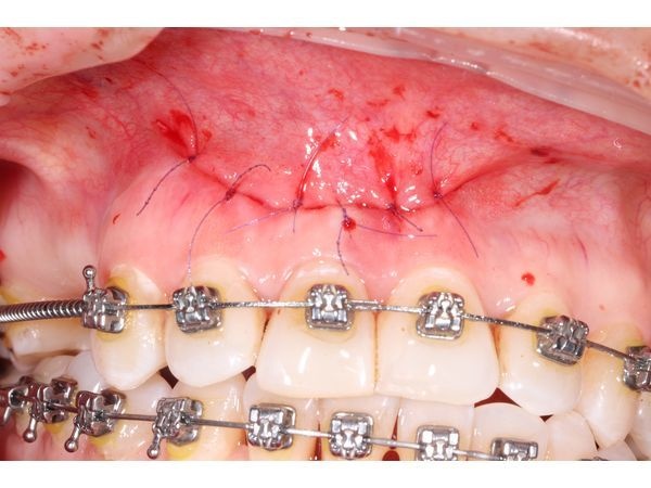 Ушивание раны после процедуры 