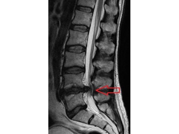 Грыжа, сдавливающая спинномозговой канал