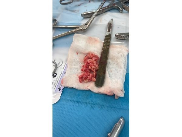 После удаления грыжи диска L4–5