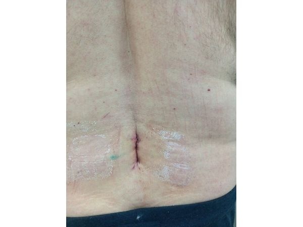 Косметический внутрикожный шов