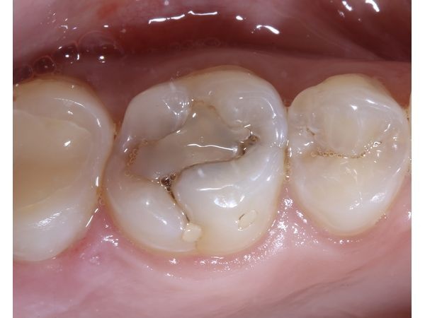 Фото до лечения Фото до лечения