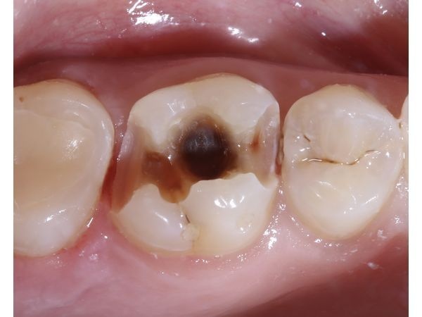 После удаления старой пломбы После удаления старой пломбы