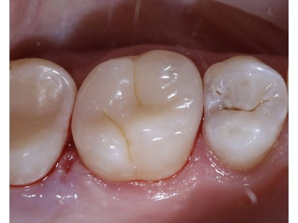 Фото после лечения Фото после лечения