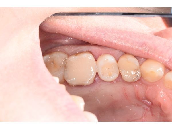 Зуб при первичном осмотре