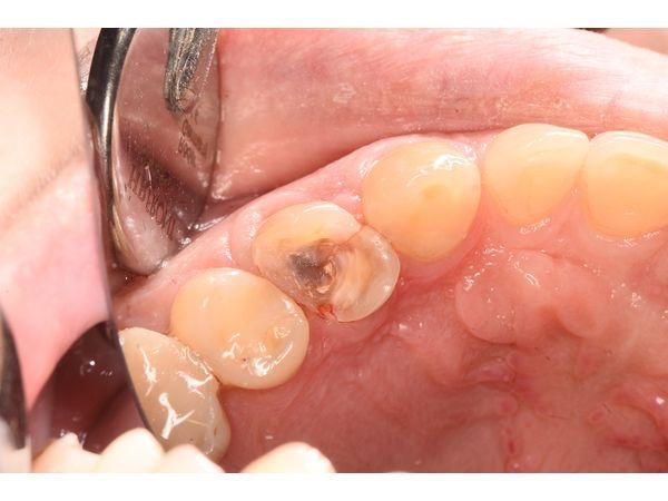 Снятие пломбы и кариозных тканей