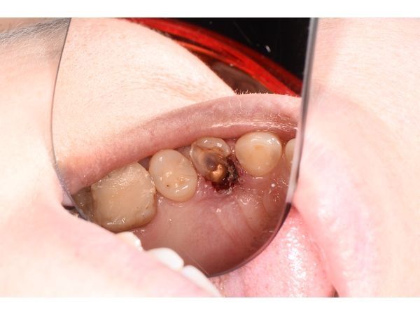 Удаление сломанной стенки зуба и осмотр глубины разрушения 