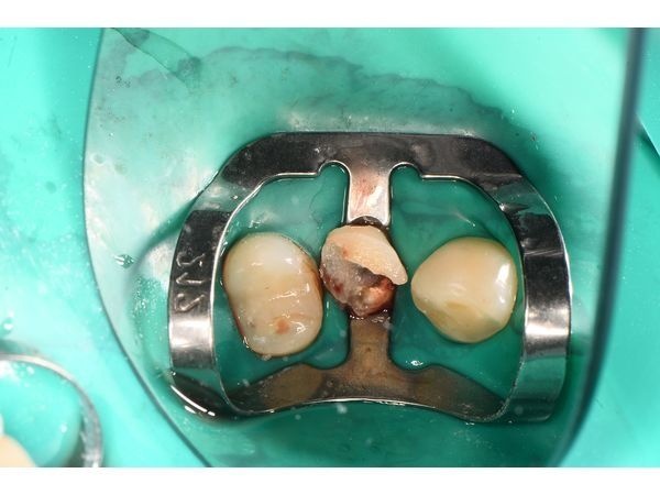 Изоляция зуба