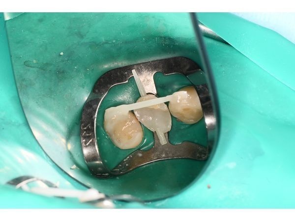 Фиксация крепления на зуб