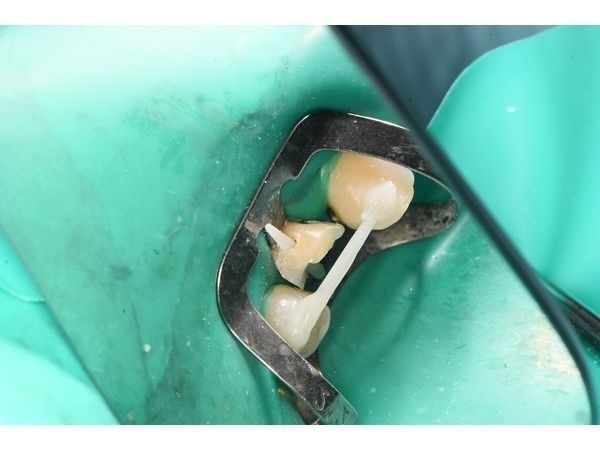 Фиксация временной балки