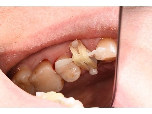 Ортодонтическая тяга