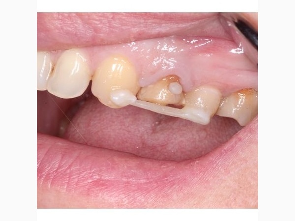 Зуб через 10 дней