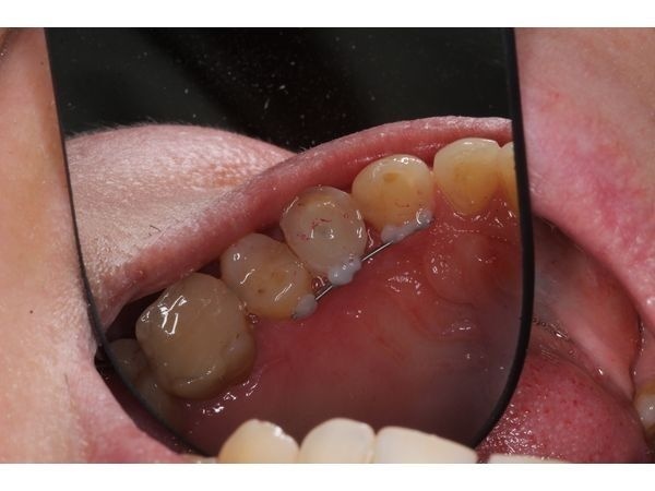 Снятие крепления, восстановление и шинирование зуба