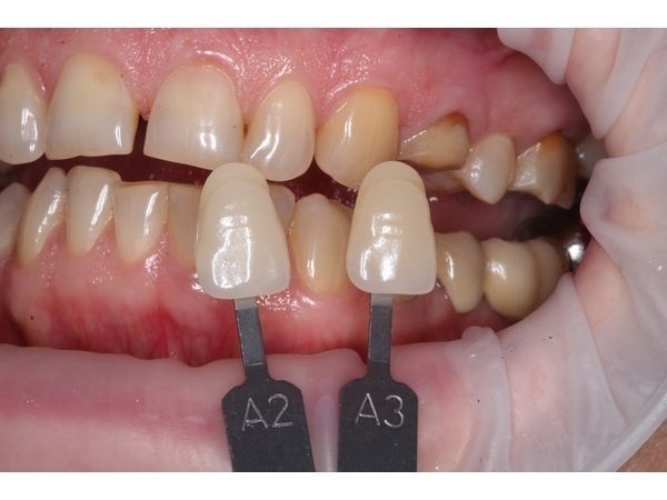 Определение цвета будущей коронки