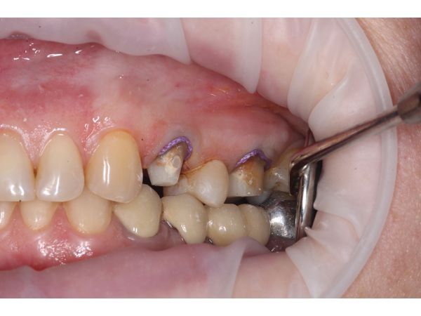 Обработка зуба под коронку