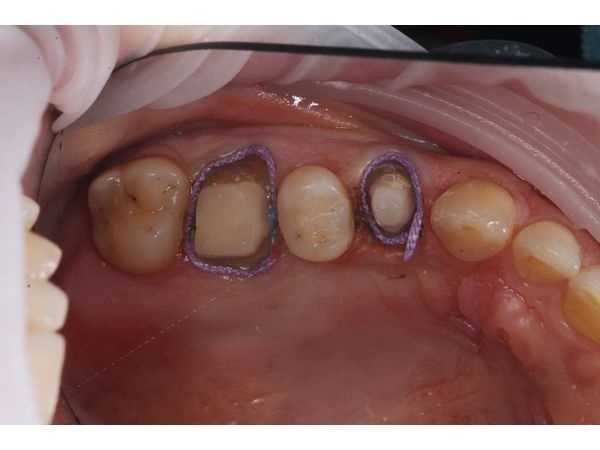 Фото перед снятием слепков