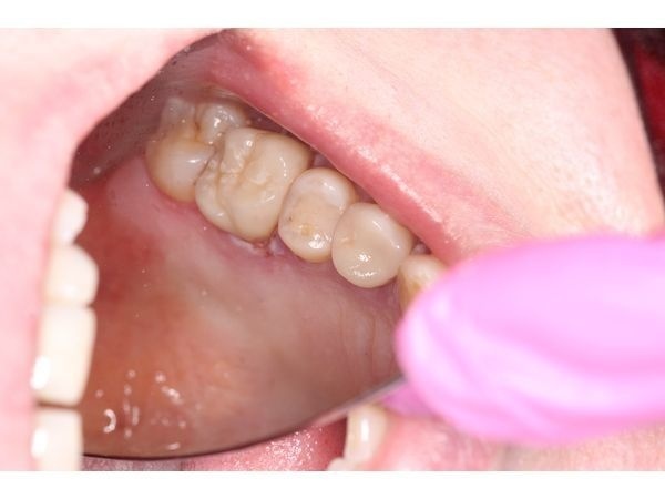 Фиксация коронок