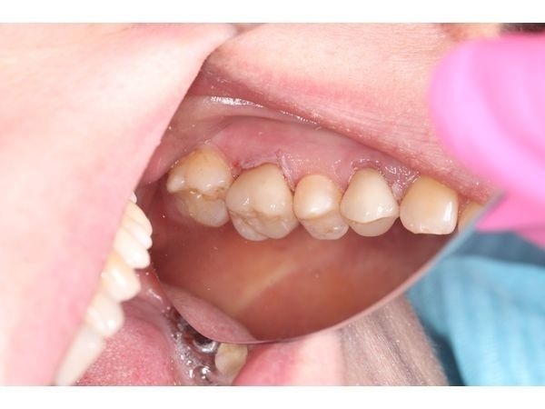 Вид с щёчной стороны сразу после фиксации