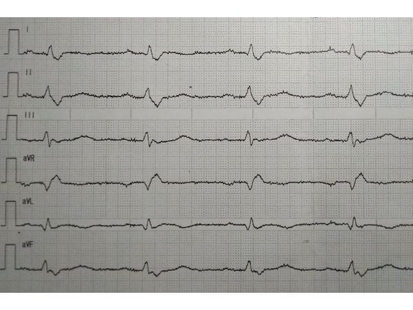 ЭКГ при поступлении (часть 1)