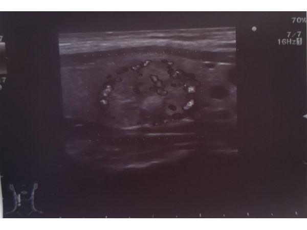 Узел в правой доле щитовидной железы