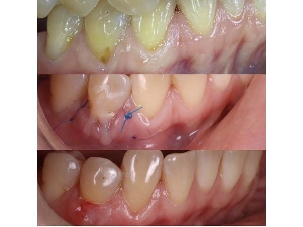 Картина до, во время и после лечения Картина до, во время и после лечения