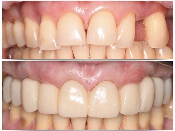 До и после лечения